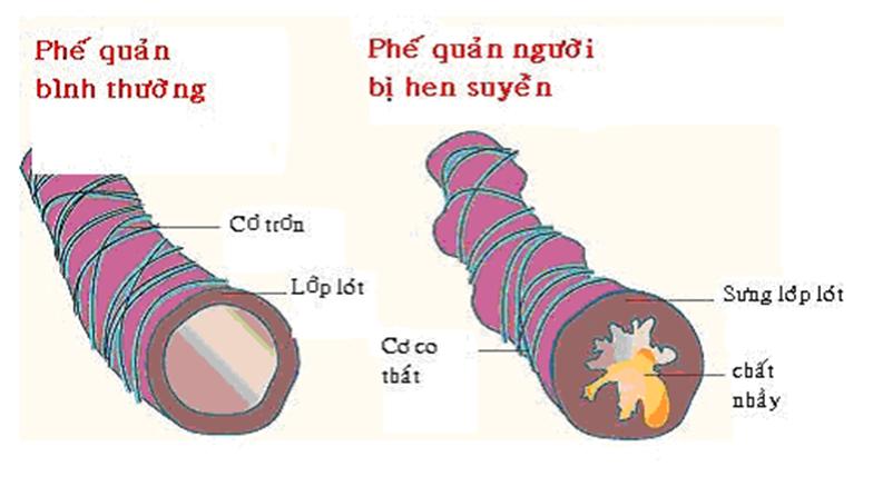 Các yếu tố dị ứng gây khởi phát Hen 