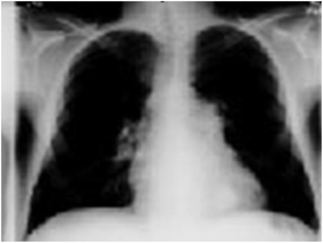 Bệnh COPD - Sát thủ vô hình