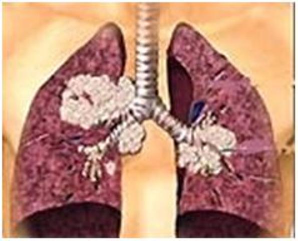 Một số điều cần biết về bệnh ung thư phổi