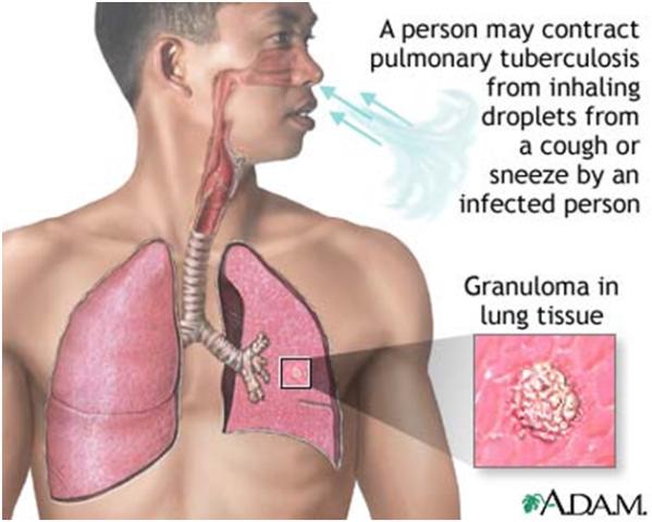 Hội chứng tràn dịch màng phổi