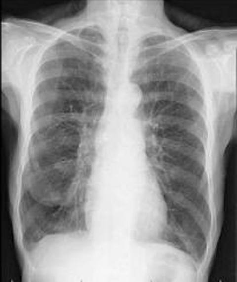 Phân biệt bệnh COPD với bệnh lao phổi