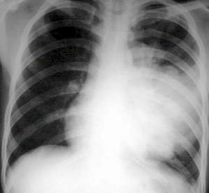 Triệu chứng lâm sàng của viêm phổi mắc phải ở cộng đồng