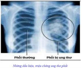 Những dấu hiệu, triệu chứng ung thư phổi