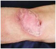 Những triệu chứng báo động bệnh lao da