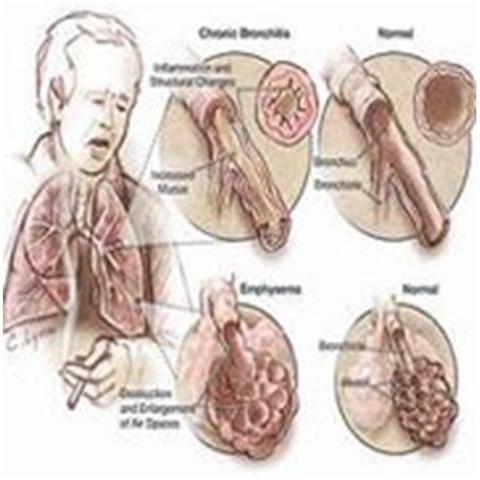 Sự nguy hiểm của bệnh phổi tắc nghẽn mạn tính