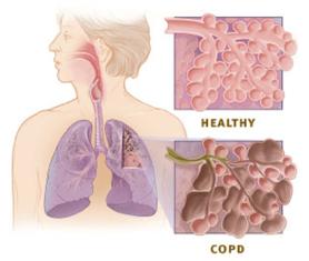 Làm gì khi nhà có người bị bệnh phổi tắc nghẽn mãn tính (BPTNMT)