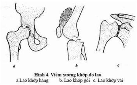 Ðừng để tàn phế vì lao xương khớp