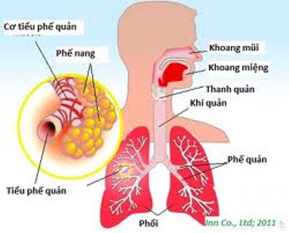 Lưu ý khi tự kiểm soát bệnh phổi mãn tính