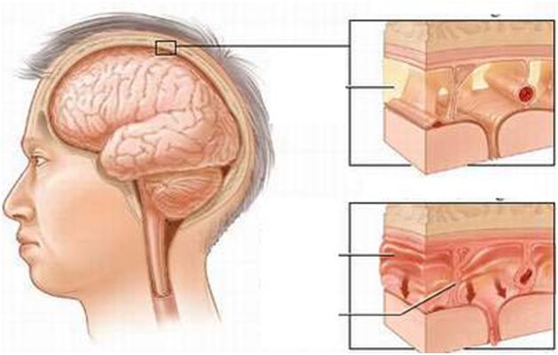 Lao màng não, bệnh ít được nhắc đến 