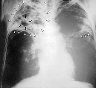 Bệnh lao phổi là gì?