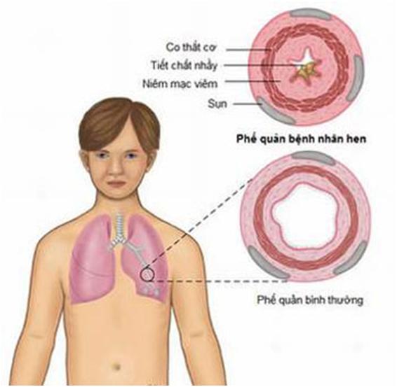 Dùng thuốc trị hen phế quản ở trẻ em thế nào cho đúng?