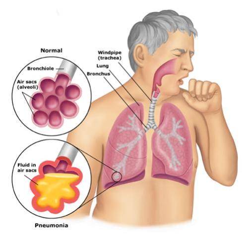 Dấu hiệu và triệu chứng của bệnh viêm phổi 