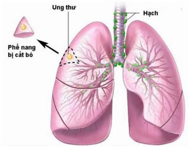 Phương pháp mới phát hiện sớm ung thư phổi