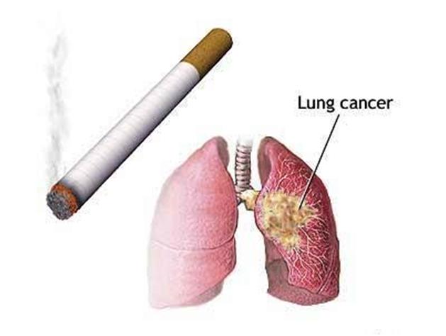 90% bệnh nhân ung thư phổi do hút thuốc lá