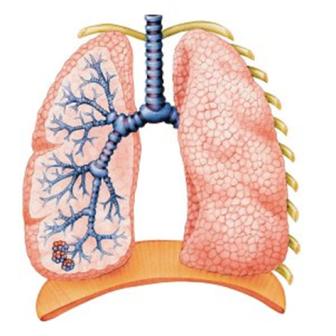 Tiến bộ về bệnh lao phổi