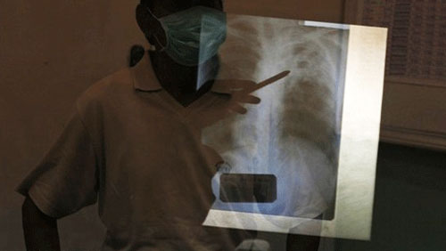 Nhận diện “thủ phạm” phá hủy phổi ở bệnh nhân lao